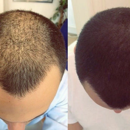 Retrouvez votre densité capillaire en 10 secondes -- Sans greffe, sans contrainte.