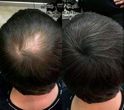 Retrouvez votre densité capillaire en 10 secondes -- Sans greffe, sans contrainte.