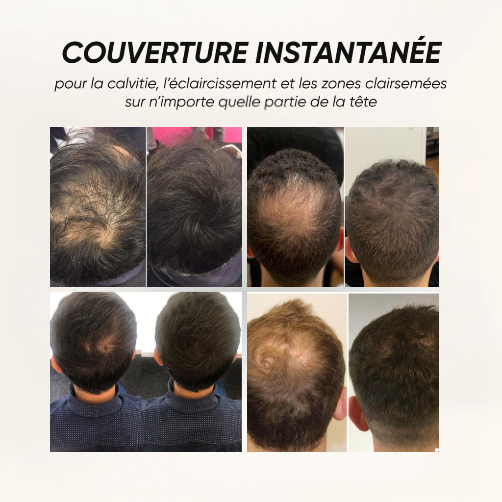 Retrouvez votre densité capillaire en 10 secondes -- Sans greffe, sans contrainte.